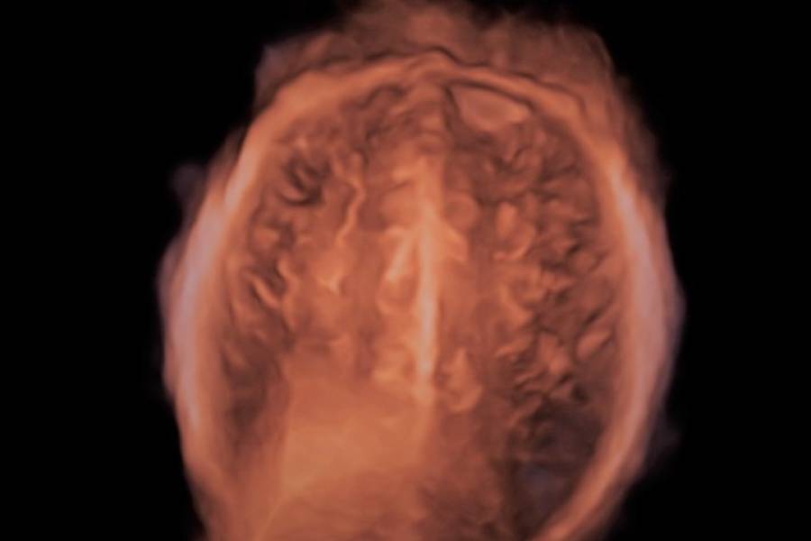 CORTECCIA FRONTALE NORMALE 1